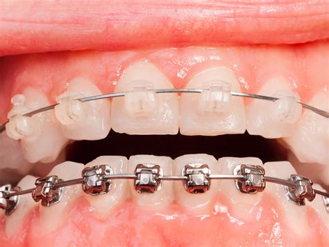 are ceramic brackets bigger than metal|ceramic vs ceramic braces.